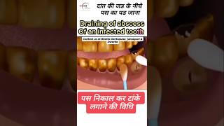 How is pus from teeth removed #pus #toothpain #rct