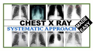 Chest X Ray Made Easy | How to read Chest X Ray | Systematic Approach to read Chest X Ray