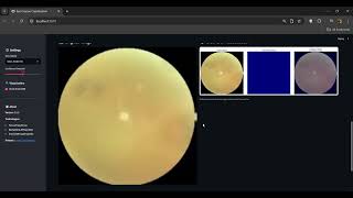 Eye Disease Classification