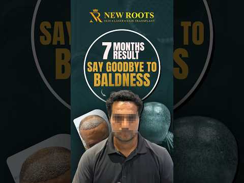 Stunning Hair Transplant Growth | Hair Transplant in Vashi #hairtransplant #vashi #shorts