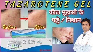 Tazarotene gel | Tazarotene cream 0.1 | Tazarotene gel 0.05 reviews, tazret 0.05 gel | tazret gel