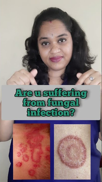 Dont ever use OTC steroid Combination creams for Fungal Infections !!!!!