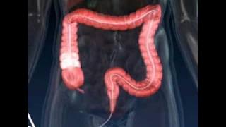 Colonoscopy - 3D Medical Animation