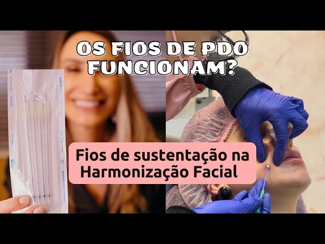 OS FIOS DE PDO FUNCIONAM? O QUE SÃO FIOS DE PDO? QUANTO TEMPO