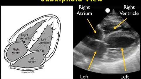 How to: Cardiac Echocardiography - Subxiphoid View