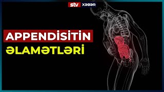 Appendi̇si̇ti̇n Əlamətləri̇ - Stv Xəbər