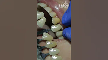 Какой цвет будущей коронки вы бы выбрали?