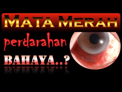 Video: Mengapa saya terus mengalami perdarahan subkonjungtiva?