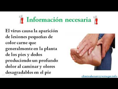 Como eliminar verrugas plantares