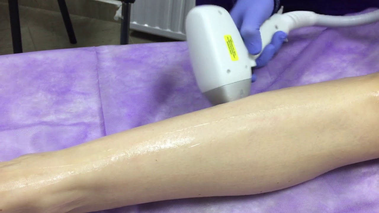 Лазерная эпиляция в Минске - YouTube
