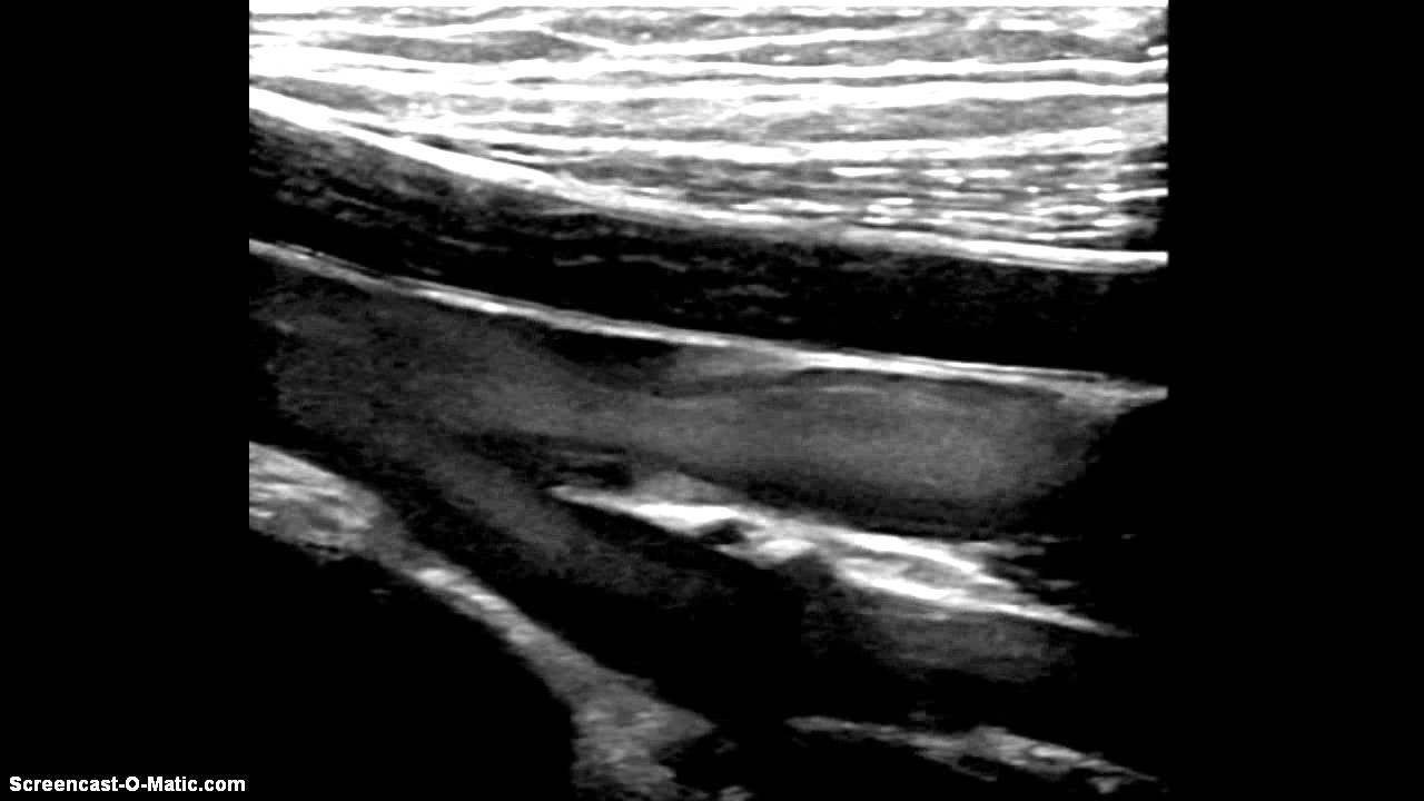 Vein with normal valve YouTube