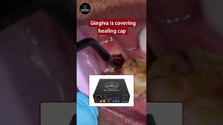 RF Advance Cautery – Precision, Safety &amp; Performance