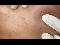 Acne Treament Under The Skin #035