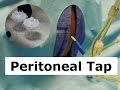 How to Do a Peritoneal Tap to Drain Ascites Fluid