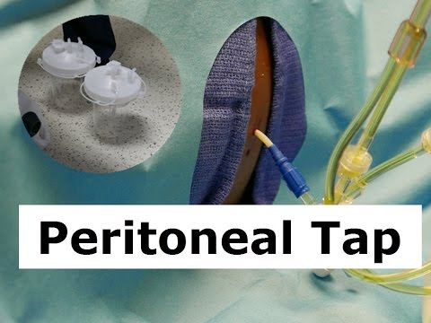 How to Do a Peritoneal Tap to Drain Ascites Fluid