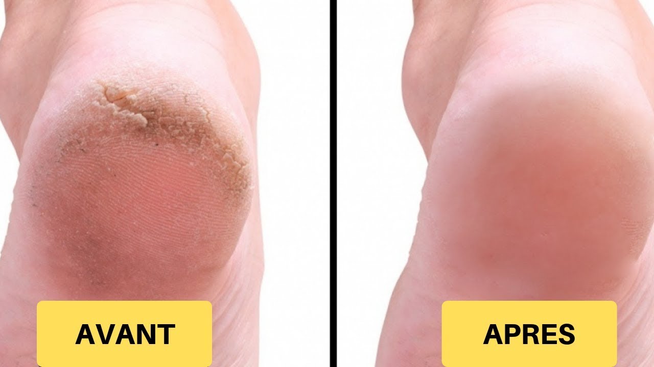 Râpe Pied Electrique Anti-Callosités