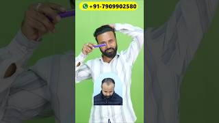 BRILLIANT HAIR TRANSPLANT RESULT #hairstyle #shorts #haircare #hairtransplant #haircut #hairgrowth