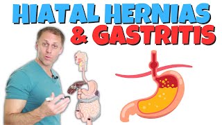 Can Gastritis Cause A Hiatal Hernia
