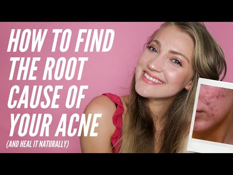 How to Find the Root Cause of Your Acne + How to Heal Your Skin ...