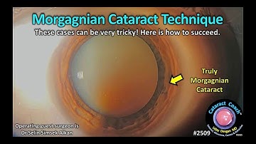 CataractCoach™ 2509: Morgagniaanse cataractoperatietechniek