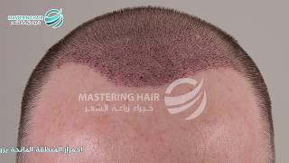 الأعراض الجانبية المعتادة بعد زراعة الشعر ليست أضرار زراعة الشعر إنها أمر طبيعي