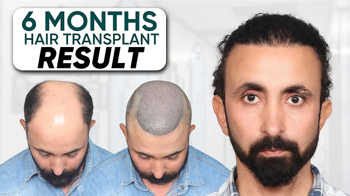 Hair Transplant Results After 6 Months | Regrowth, Hairline & Density