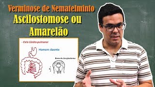 Ancilostomose, Amarelão ou Doença do Jeca Tatu Ancilostomose, Amarelão ou Doença do Jeca Tatu