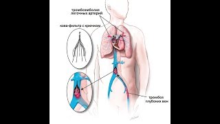 Установка временного кава фильтра и операция его извлечения из нижней полой вены