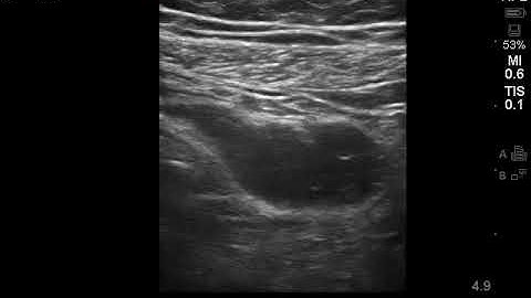 Case 4 : Perforated Appendicitis
