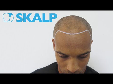 Scalp Micropigmentation Before and After Transformations at Skalp®