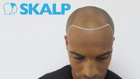 Scalp Micropigmentation Before and After Transformations at Skalp®