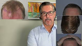 Excellent fine hair transplant result in 50 year old 2 years after hair restoration with Dr. Lindsey