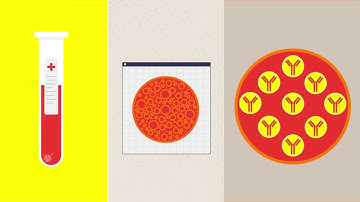 An introduction to MGUS (Monoclonal Gammopathy of Unknown Significance)