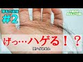 抜け毛が多いと薄毛になる？～薄毛迷信②～