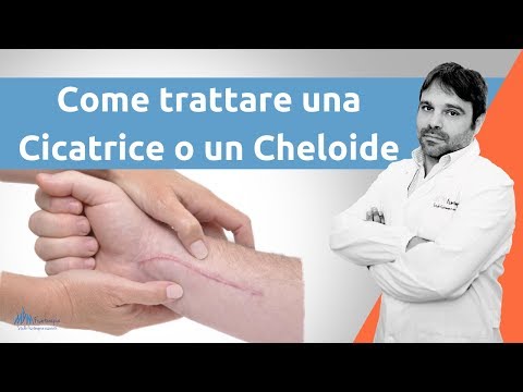 Come trattare una cicatrice cheloide