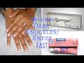 How I Cleared my Knees/knuckles(1)_Using Hyprogel/Fashion Fair