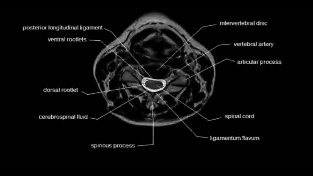 Mri Read Cervical Spine Axial Viewanatomy Of Cervical Spine Axial