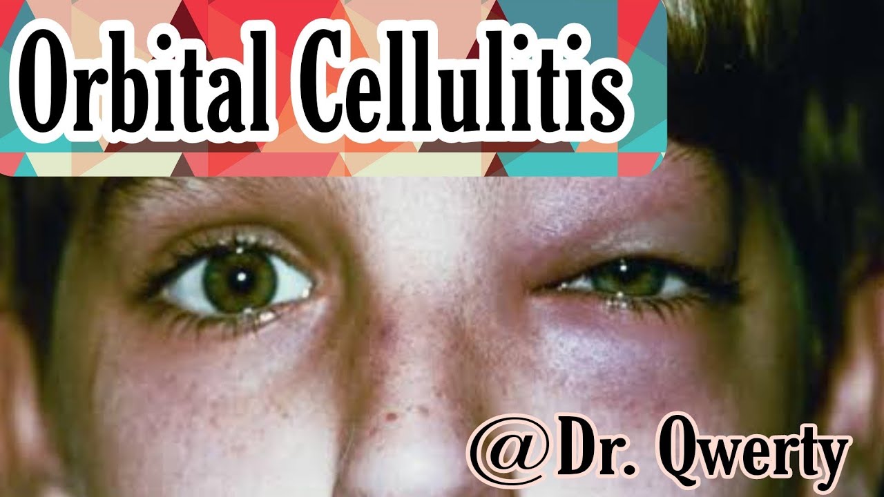 Orbital Cellulitis | Clearly explained | Ophthalmology | MBBS | Dr ...