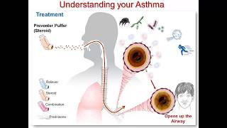 Understanding Your Asthma Part 3: Steroid Medication