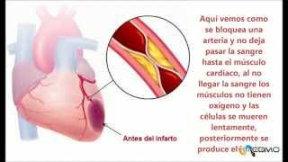 Por qué tenemos un infarto de miocardio