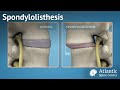 Spondylolisthesis