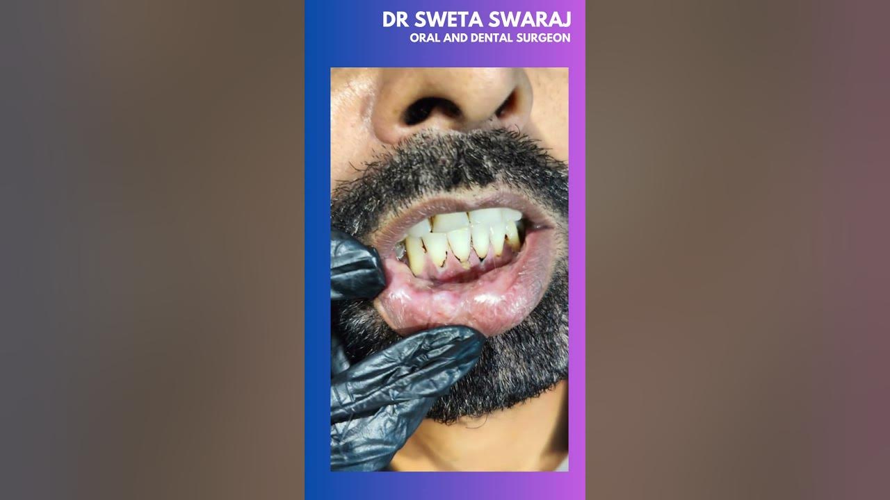 Mucocele Case I Oral Health I Dental Treatment I Oral Treatment YouTube