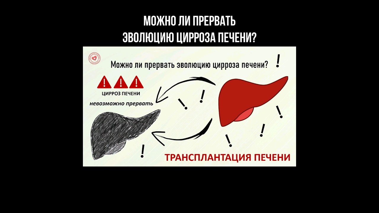 Можно ли прервать эволюцию цирроза печени? #циррозпечени #цирроз #печень #трансплантация