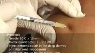 Celluform injection video