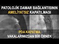 PDA KAPATMA | Örnek vaka