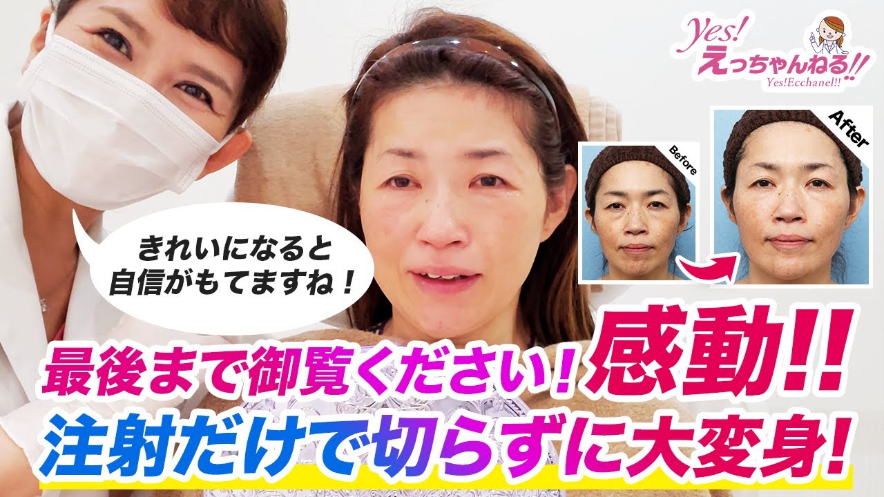 これが高須クオリティ！感動！切らずに大変身！ヒアルロン注射・ベビーコラーゲン注射