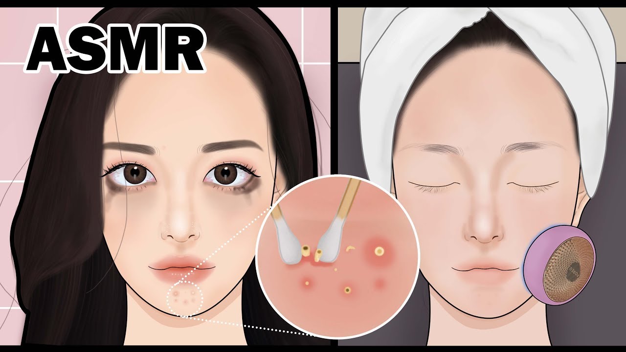 ASMR Skin Care Animation Pimple popping Acne treatment relaxingvibes 