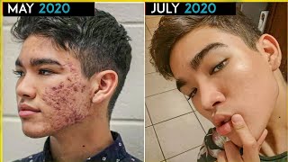 Pimple Kyu Hote Hai | Reason Of Pimples On Face | पिंपल क्यों होते हैं | The Stud Man