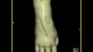 Musculoskeletal: 3D Hand Soft Tissue: CT angiogram reconstruction: Volume rendering screenshot 4