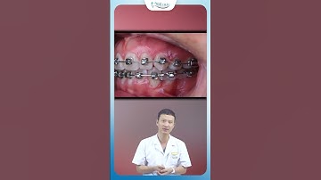 Kéo Răng Ngầm Khi Niềng Răng | Nha Khoa Minh Châu